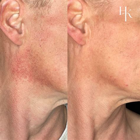 Poikiloderma van Civatte - Huidkliniek Twente