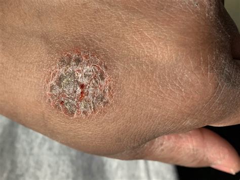 Nummular Eczema Vs Ringworm
