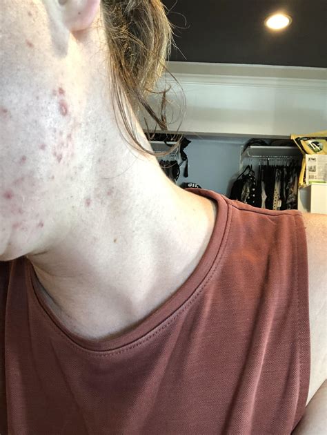 Cystic Acne On Neck