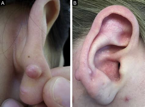 Keloid formation following ear piercing through the transitional zone ...