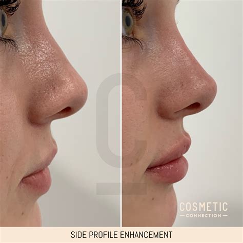 Side profile enhancement | Nose fillers, Nose shapes, Rhinoplasty nose jobs