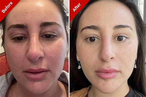 Ozempic Face: Before And After Considerations