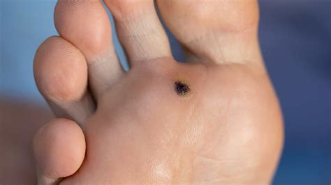 Plantar Warts | Causes, Symptoms & How to Get Rid of Them