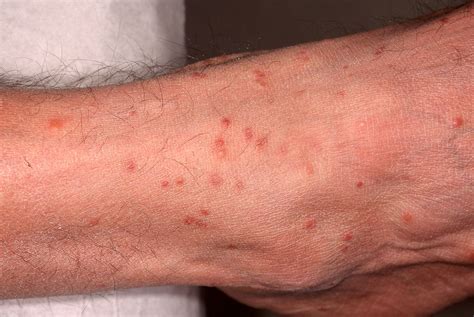 Pathology Outlines - Dermal hypersensitivity reaction