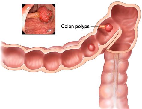 Colon Polyps - Causes, Signs, Symptoms, Prevention,Treatment