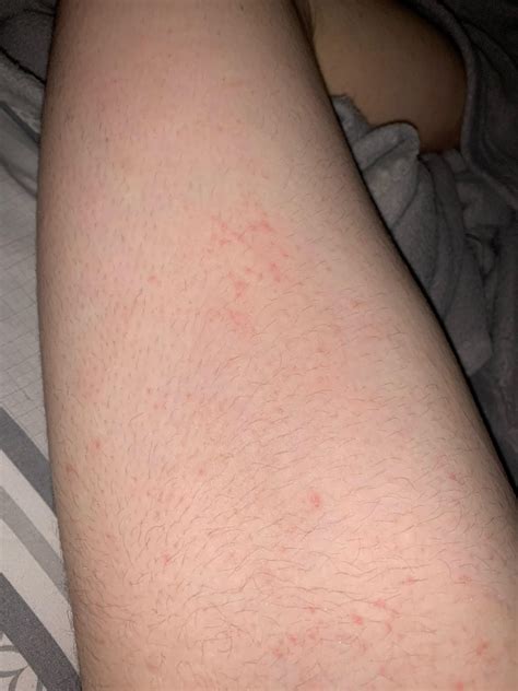 Spots with uncontrollable itch all over body : r/DermatologyQuestions