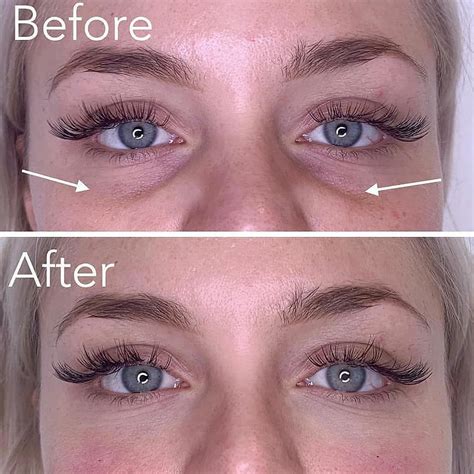 The BEST in Cosmetics on Instagram: “Before/after tear trough filler for dark under eye circles ...