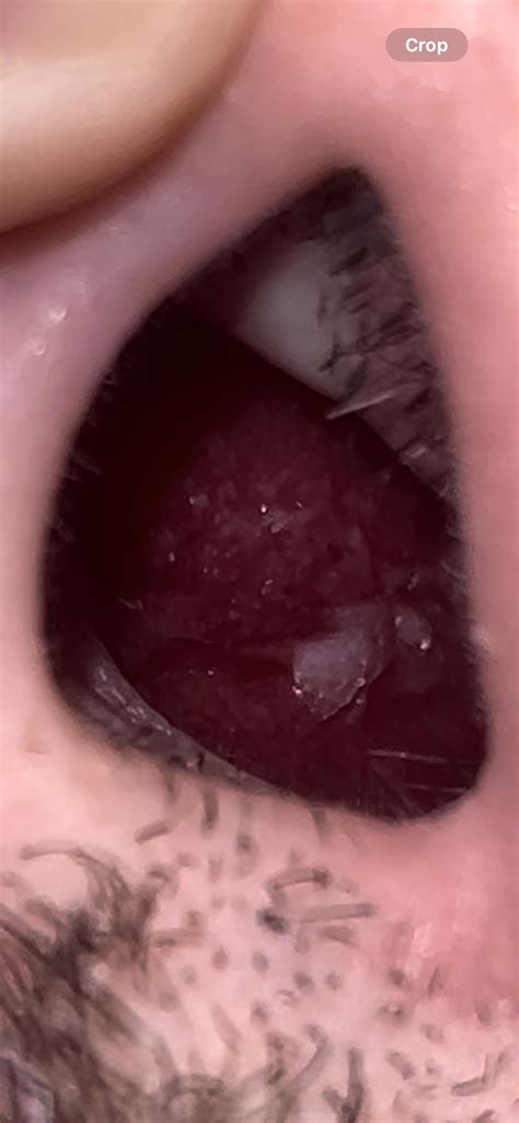 Nasal Lining Scab : r/Sinusitis