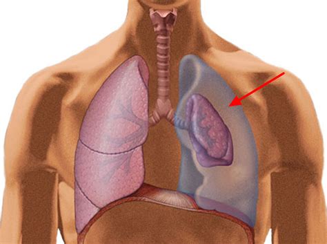 Pneumothorax - Causes, Signs, Symptoms, Treatment