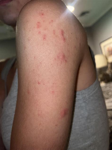 Pimples On Arms