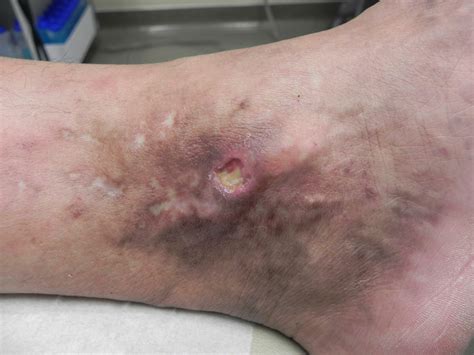 Chronic Venous Stasis Ulcers