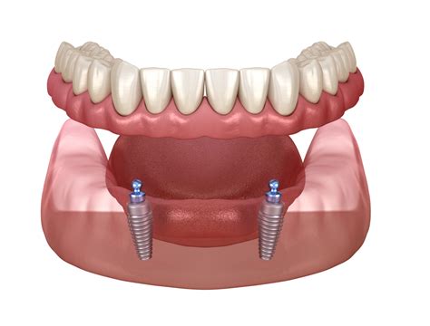 Implant Retained Dentures | HQ Dental, Leeds, UK