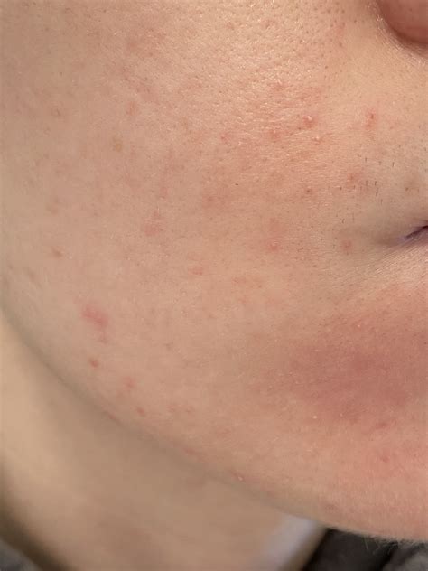 Gram Negative Folliculitis