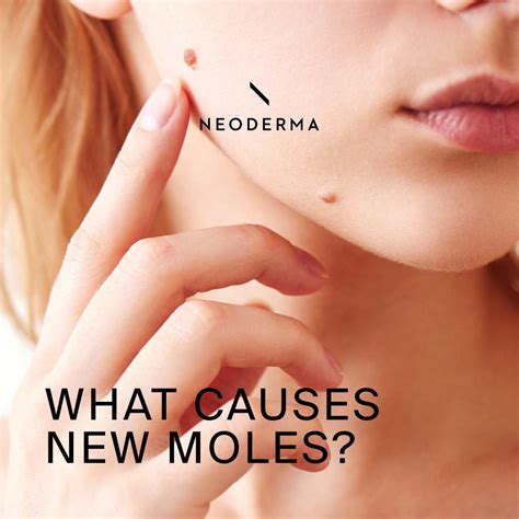 What Causes New Moles? – NEODERMA