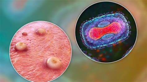 India Reports First Suspected Mpox Case, Patient Put Under Isolation ...