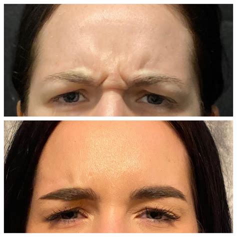 Neurotoxins: Botox® & Daxxify® Treatments for Wrinkle Reduction