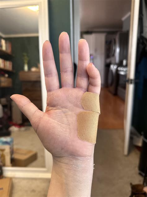 Boxers fracture recovery - my pinky is crooked/bent : r/brokenbones