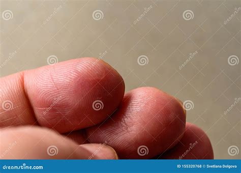 Close Up Wet Callus or Blister on the Hand Finger, Healthcare and Medical Concept Stock Photo ...