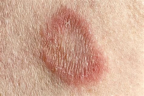 How to Spot Differences Between Eczema, Ringworm, and Psoriasis