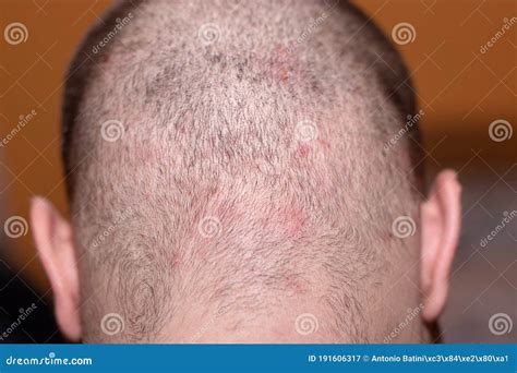 Scalp Acne