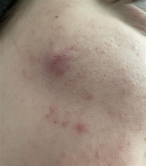 I use boots Tea Tree and witch Hazel face wash and spot stick twice a day. Why am I still ...