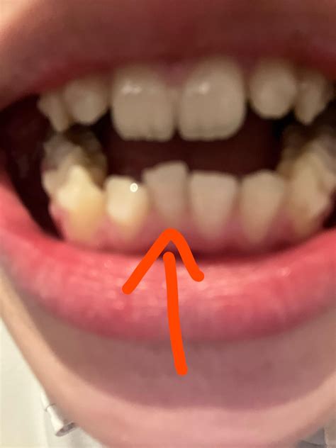 sudden tooth sensitivity? : r/Invisalign