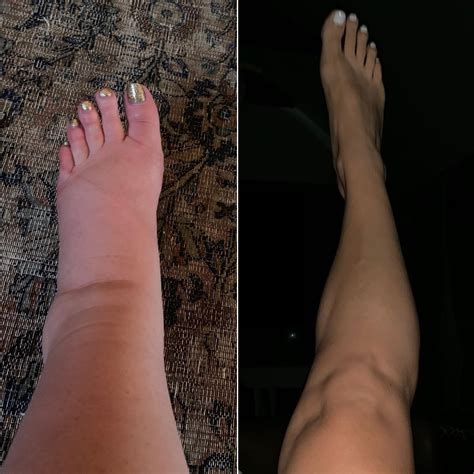 List 97+ Pictures Photos Of Swollen Ankles Completed
