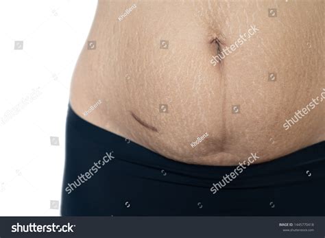 Appendix Surgery Scar: Over 320 Royalty-Free Licensable Stock Photos | Shutterstock