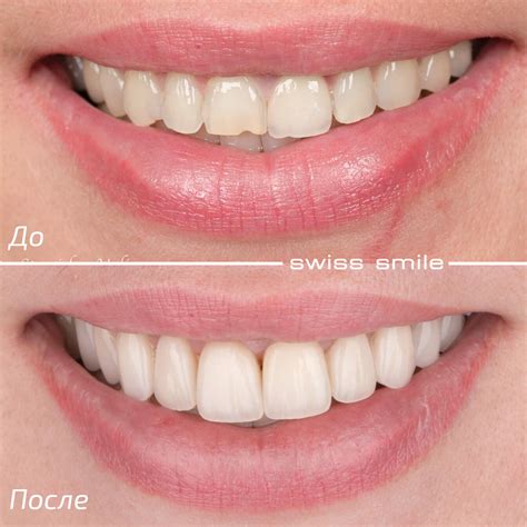 Керамическая реставрация зубов фото до и после – Swiss Smile