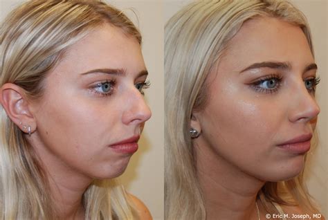Chin Strap After Plastic Surgery at Amelie Coxen blog