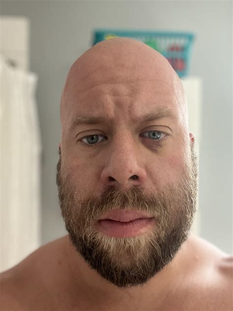 Woke up a few days ago with swelling on my lower eyelid. Today swelling is lower, but now area ...