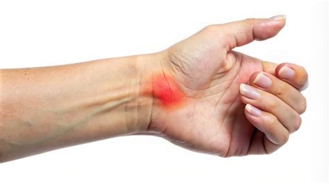 Effective Treatments for Ganglion Cysts: From Home Remedies to Surgical ...