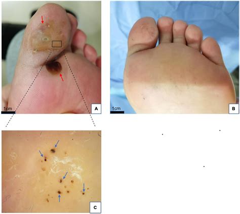 Plantar Wart Urine Treatment at Alana Saltau blog