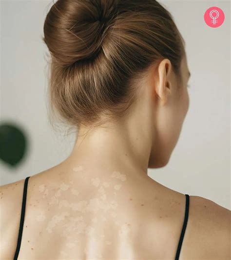 Tinea Versicolor Home Remedies