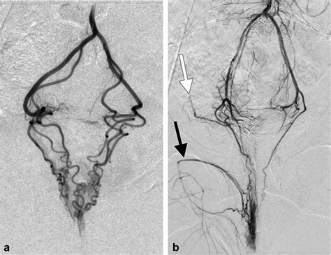 Superior Rectal Artery Embolization for Symptomatic Grades 2 and 3 Hemorrhoidal Disease: 6-Month ...