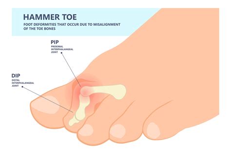 Hammer Toe Symptoms
