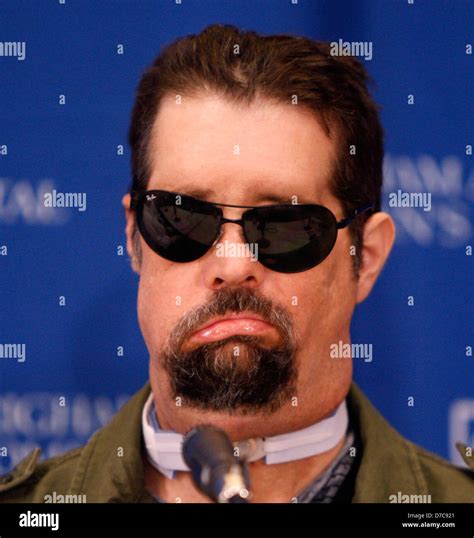 Dallas Wayens Face Surgery