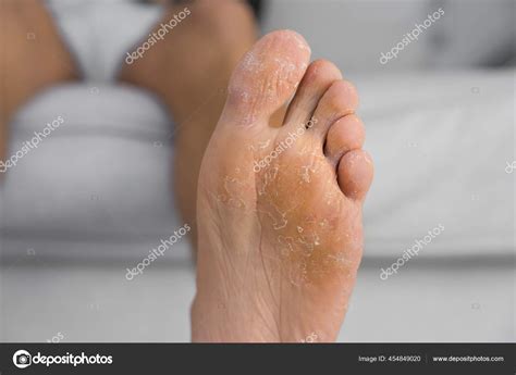 Close up of peeling and cracked foot. Fungal infection or athletes foot ...