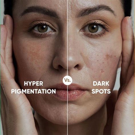 Hyperpigmentation Age Spots | Face And Body Adelaide