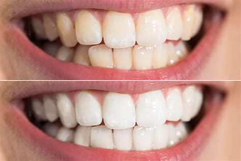Why Do I Have White Streaks On My Teeth at Tim Dodd blog
