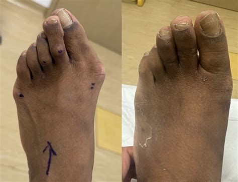 Tailor’s Bunionette Surgery: Causes, Symptoms & Keyhole Treatment Explained - Bunion Surgeon London