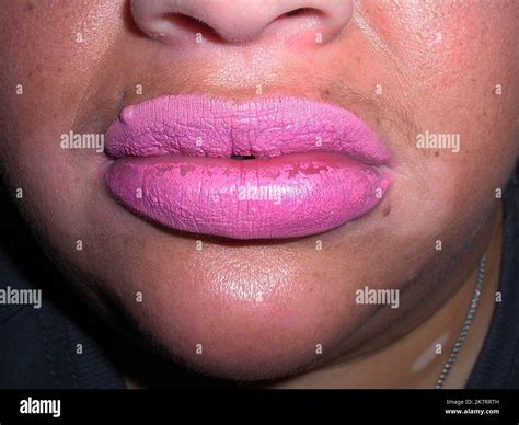 Swollen lips of a female patient caused by angioedema (angioneurotic oedema). This is an ...