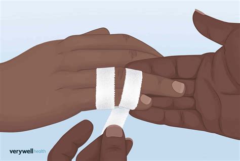 How to Treat a Sprained Finger