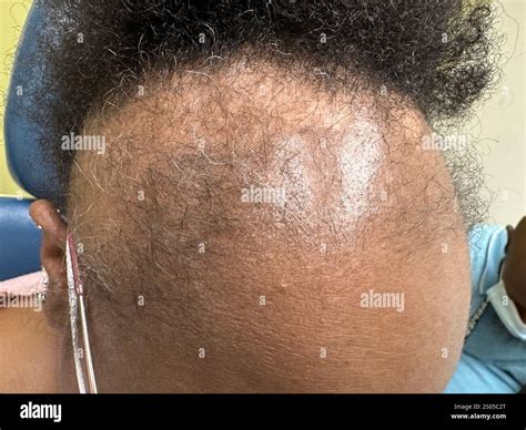 Frontal fibrosing alopecia. This is a form of scarring hair loss along the hairline at the front ...