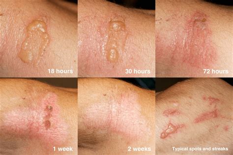 Poison Hemlock Rash: Symptoms, Prevention and Treatment - Welzo