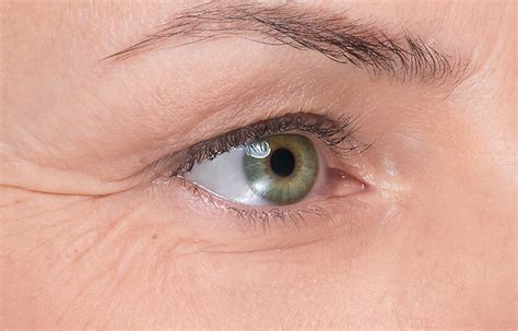 Wrinkles Around Eyes Crows Feet at Eileen Crofts blog