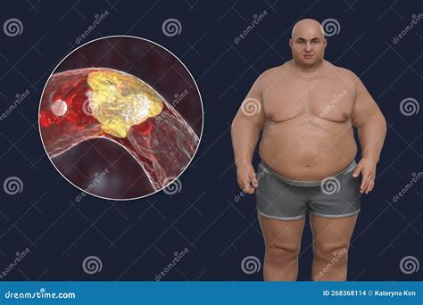Obesity and Atherosclerosis, Conceptual 3D Illustration. Atheromatous ...