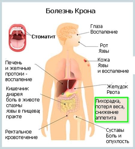 Болезнь Крона: симптомы, диагностика, лечение и диета, прогноз жизни