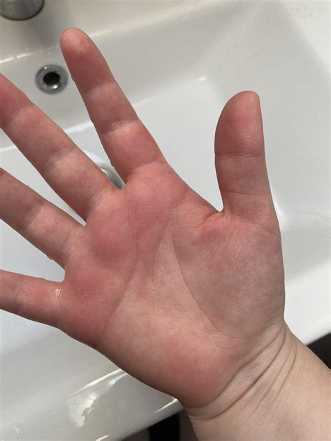 Rash On Palms Of Hands