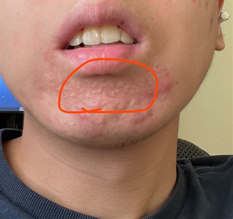 Raised bumps on chin : r/Skincare_Addiction